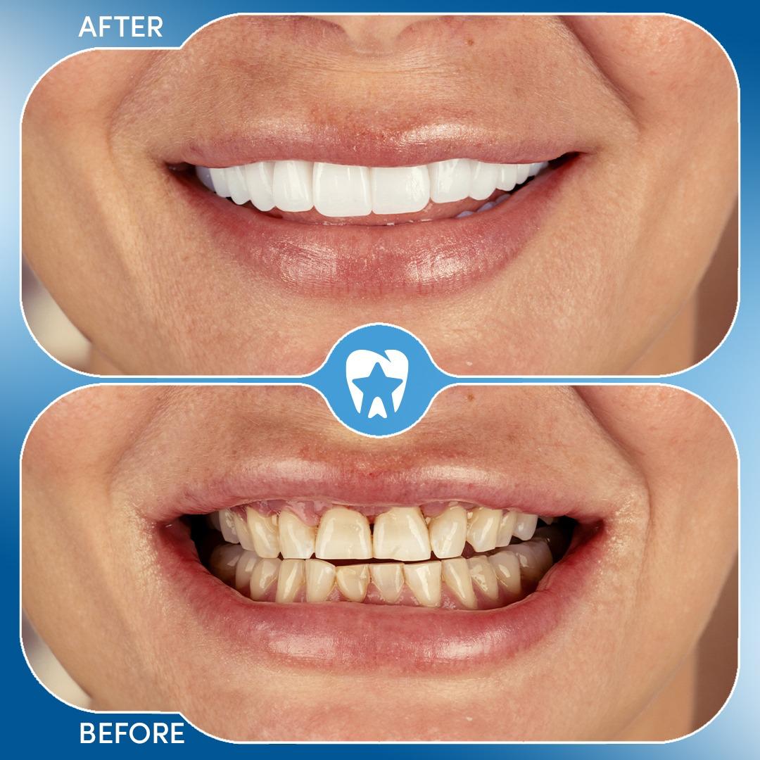 Before and after dental treatment